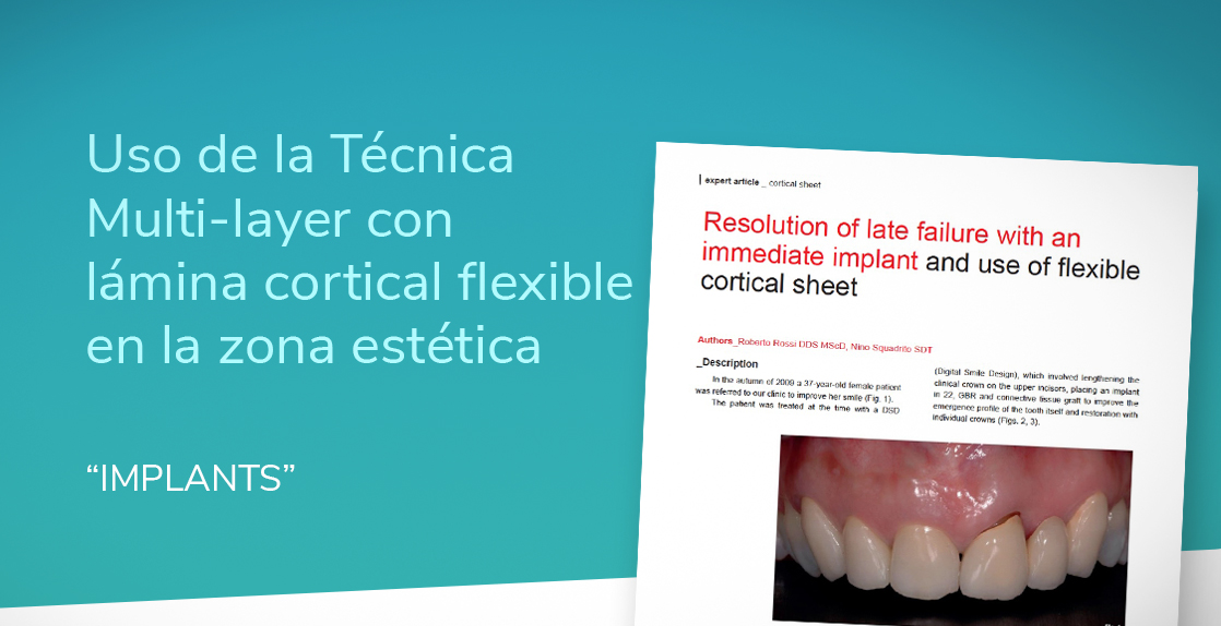 Flex Cortical Sheet